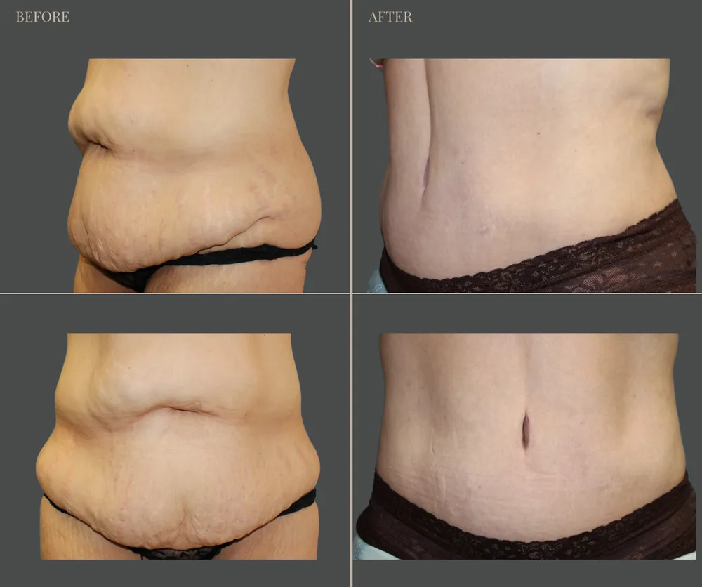 Tummy Tuck Before & After result 22