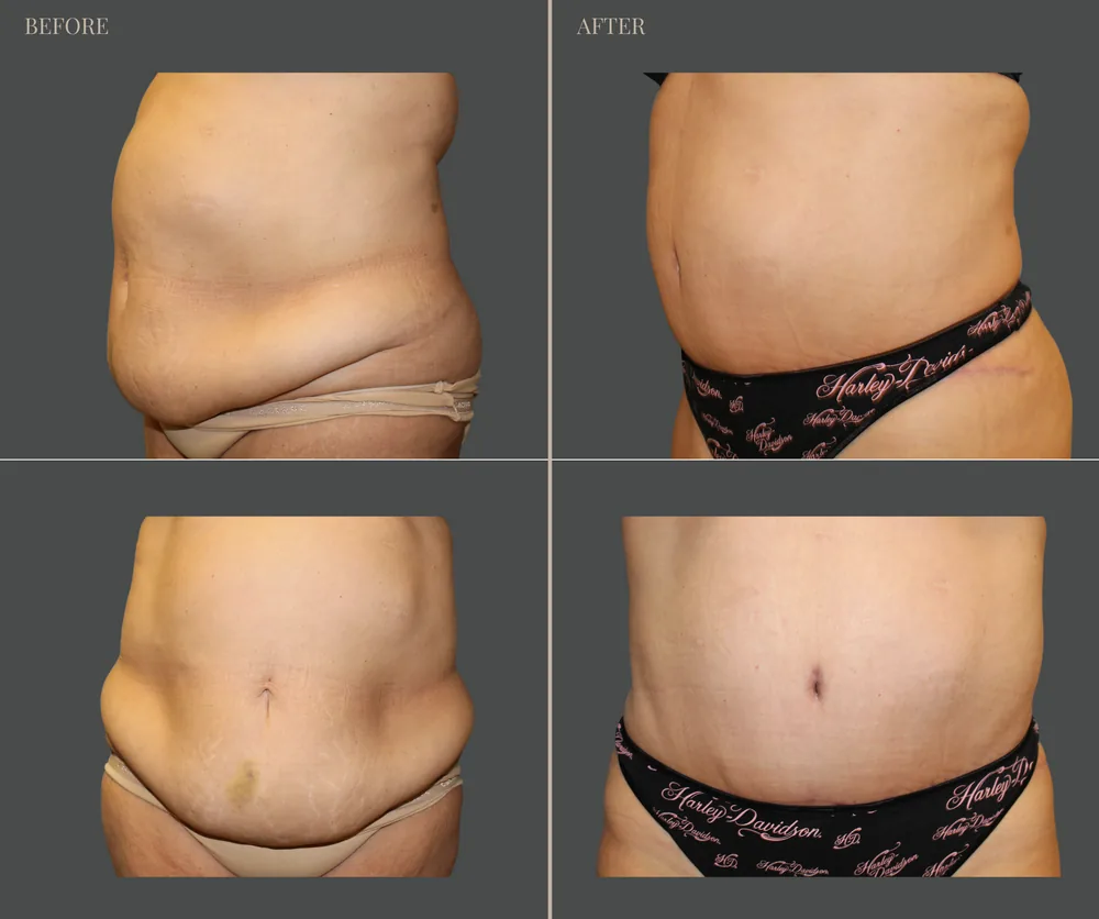 Tummy Tuck Before & After result 33