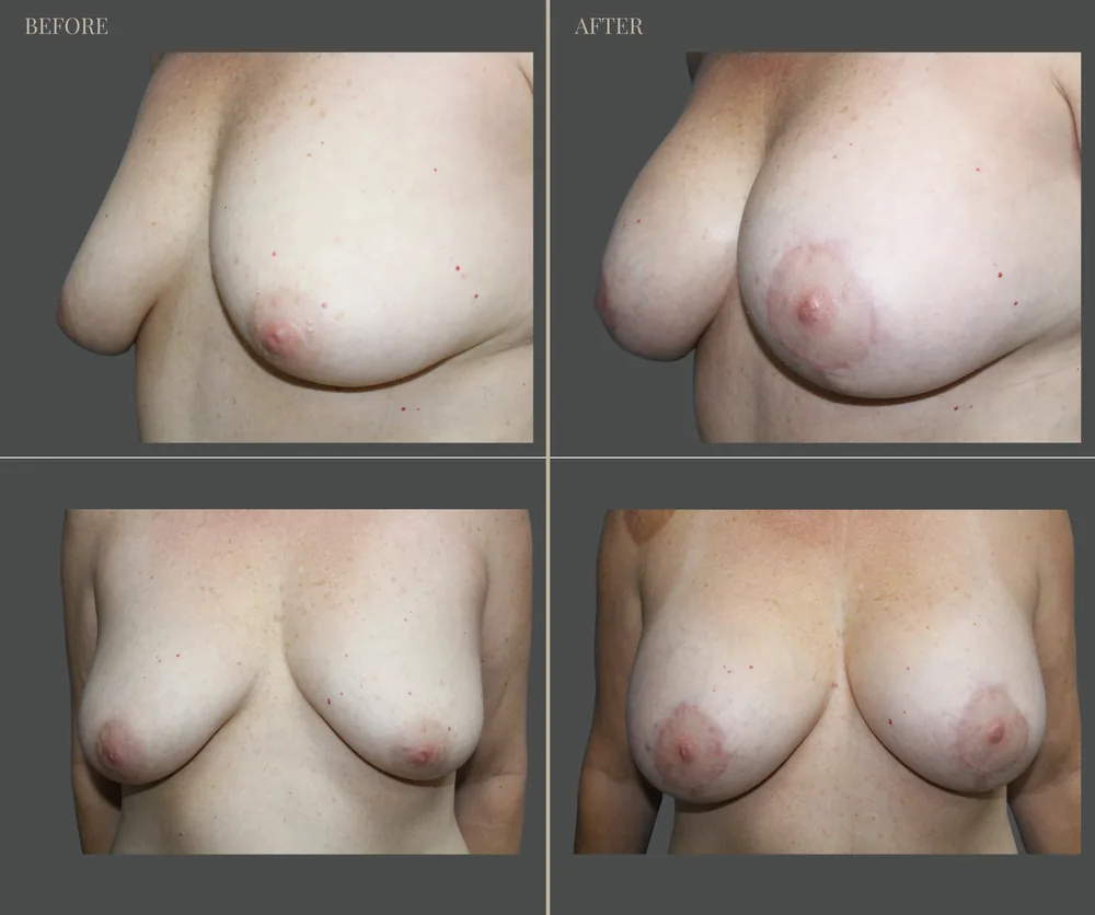 Breast Augmentation Before & After result 6