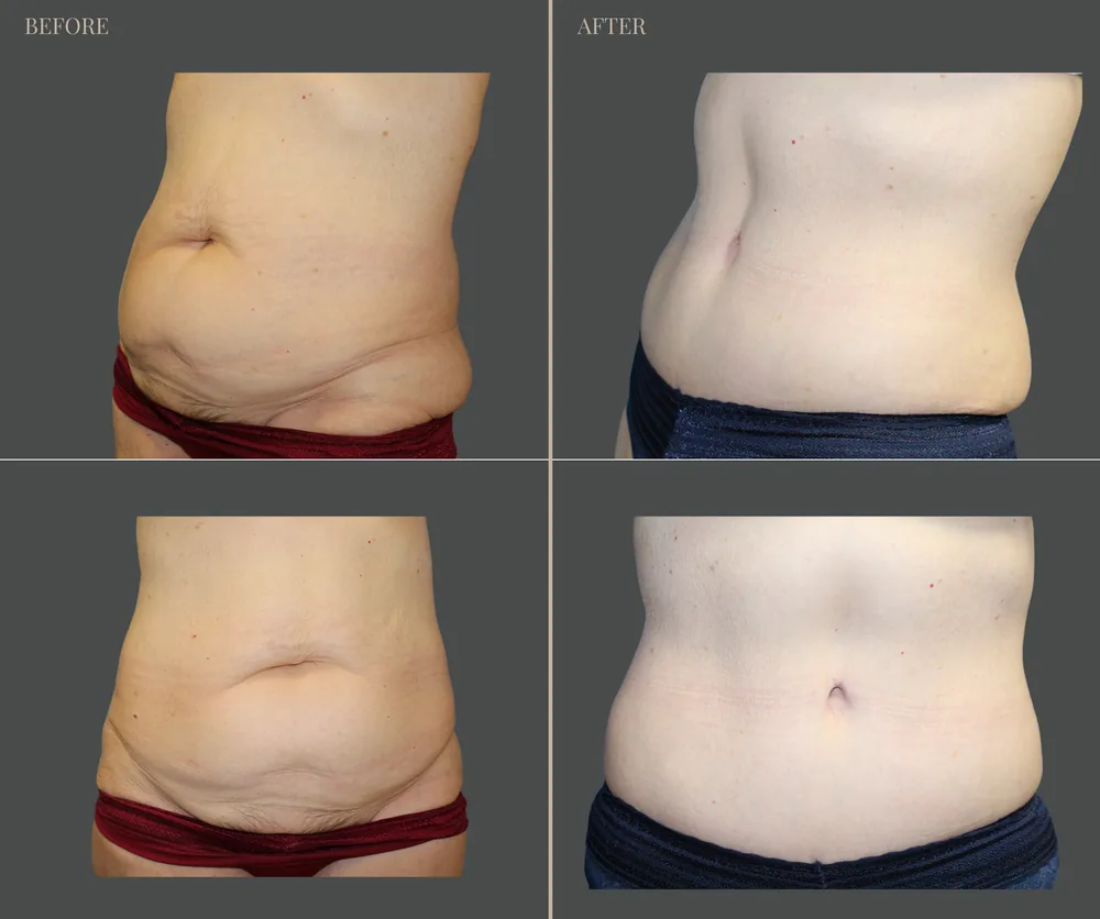 Tummy Tuck Before & After result 41