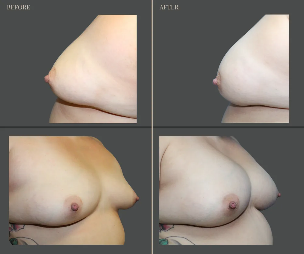 Breast Augmentation Before & After result 24
