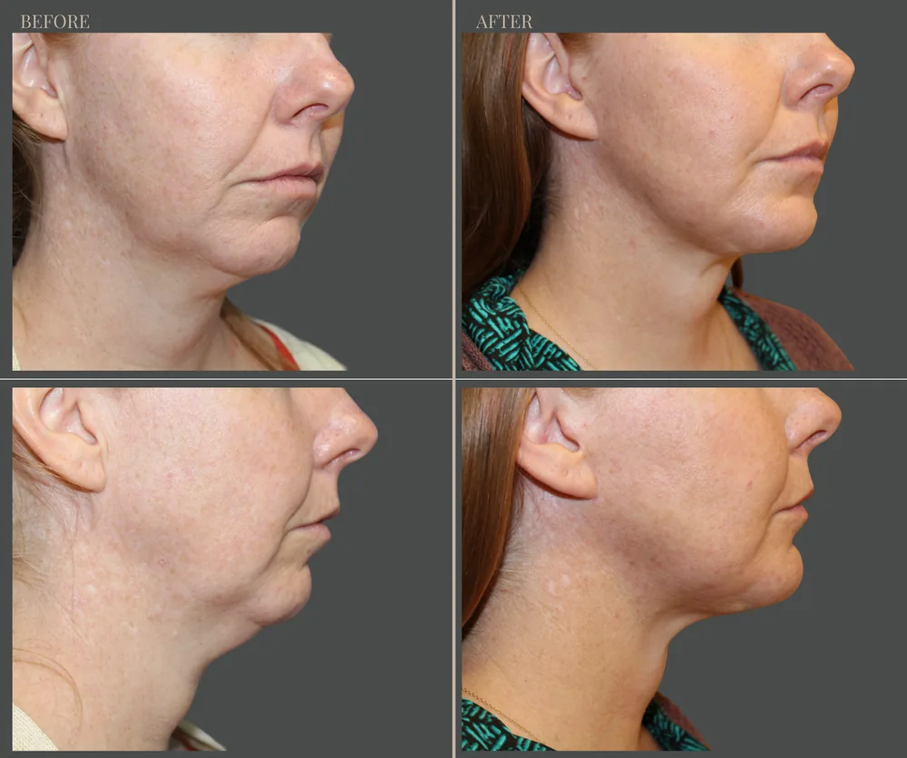 Neck Lift Before & After result 8