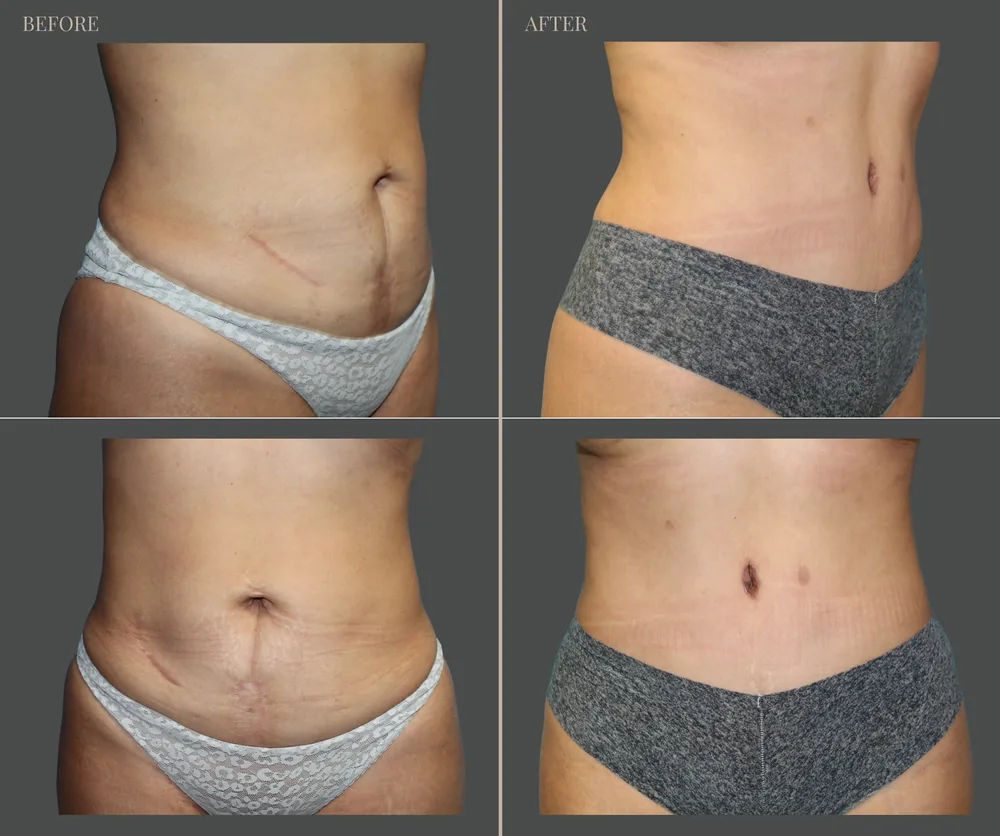 Tummy Tuck Before & After result 4