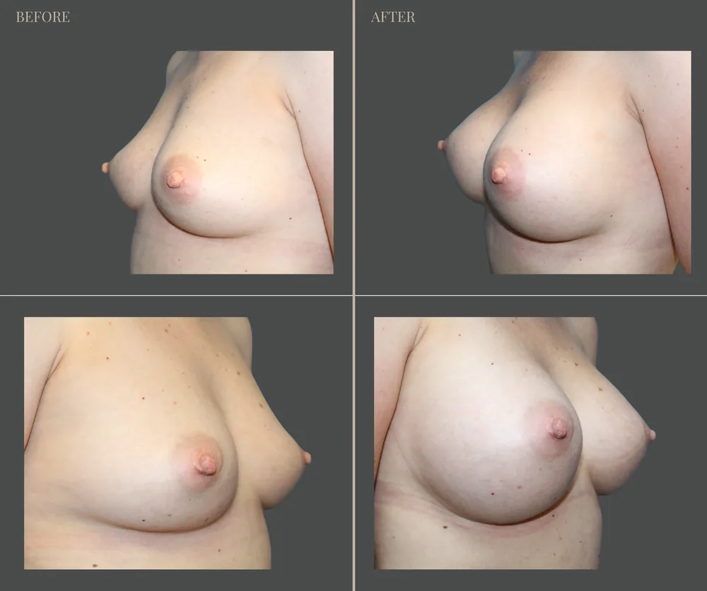Breast Augmentation Before & After result 4