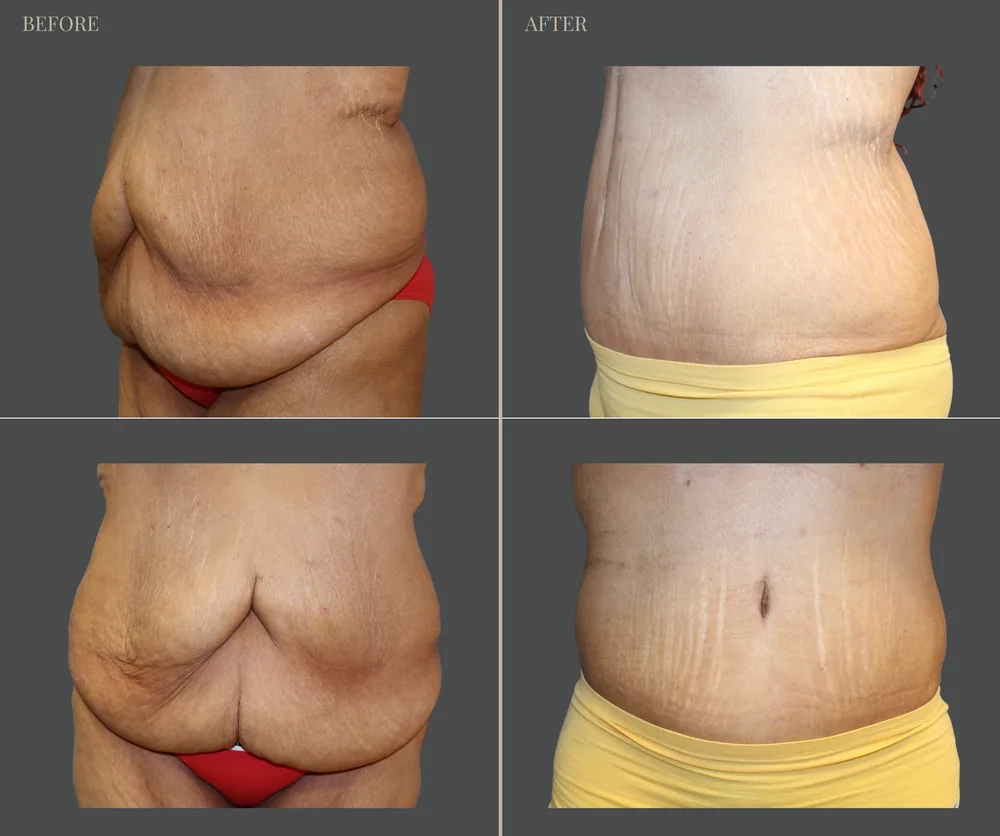 Tummy Tuck Before & After result 28