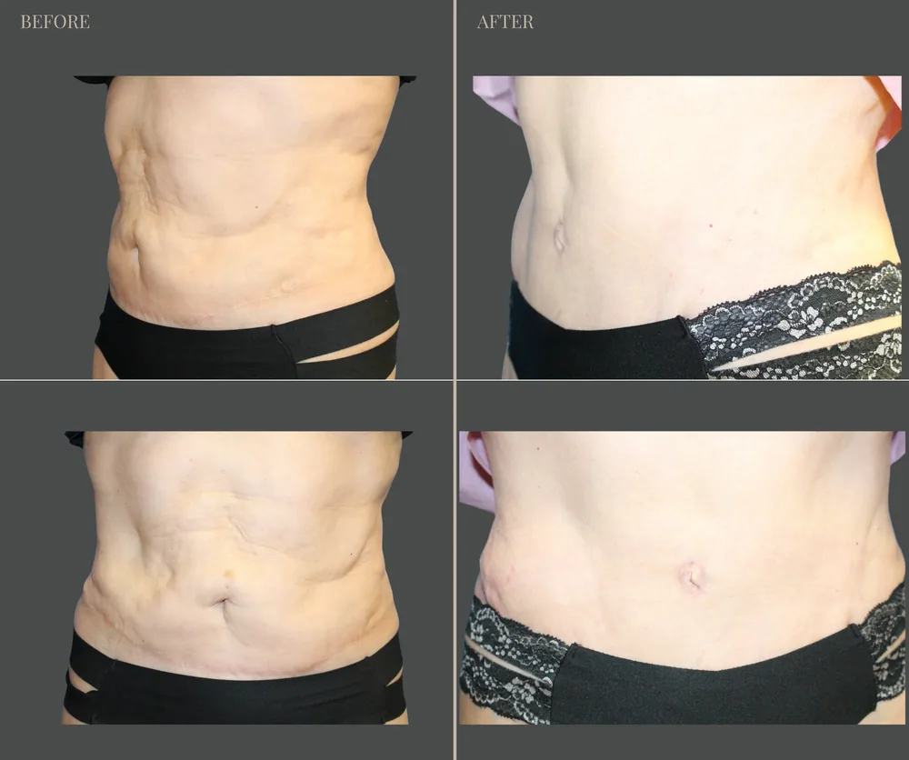 Tummy Tuck Before & After result 23