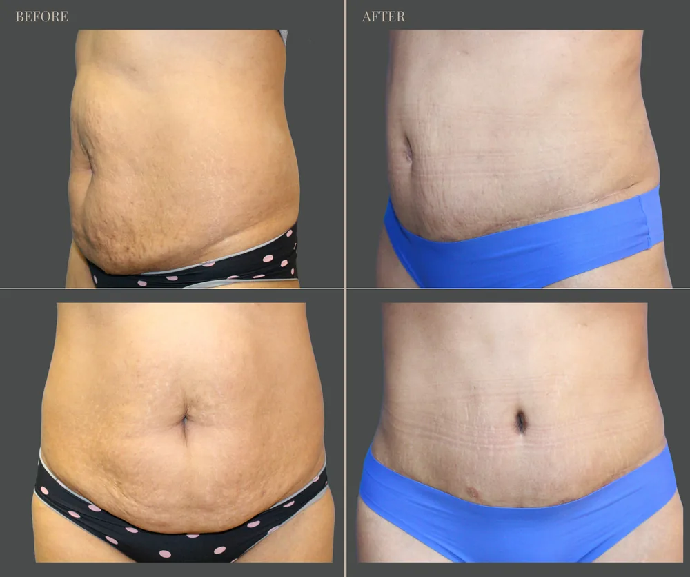 Tummy Tuck Before & After result 10
