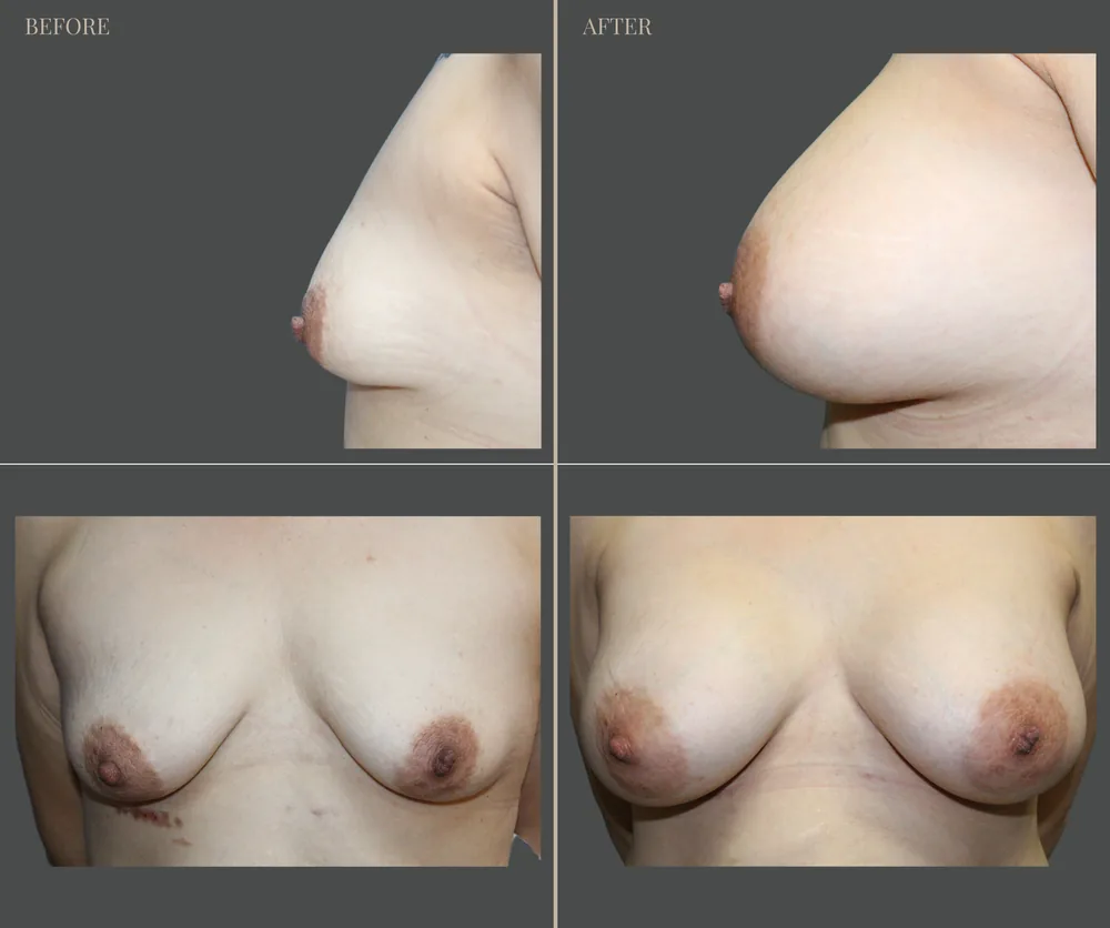 Breast Augmentation Before & After result 21