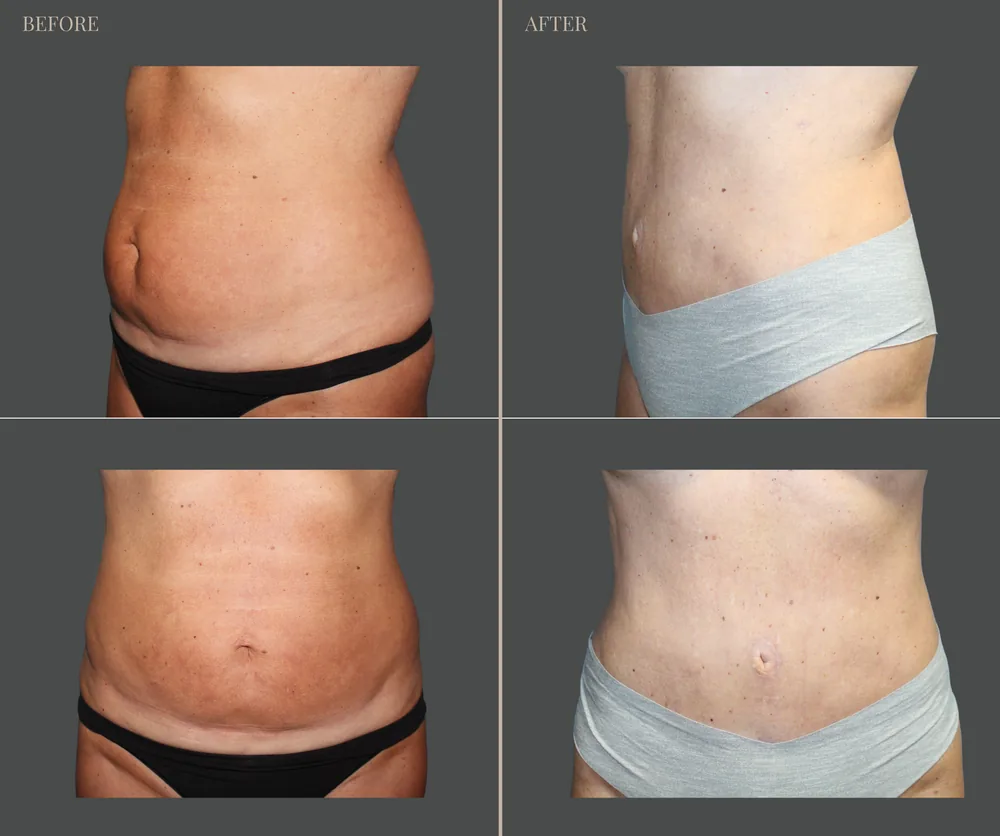 Tummy Tuck Before & After result 30