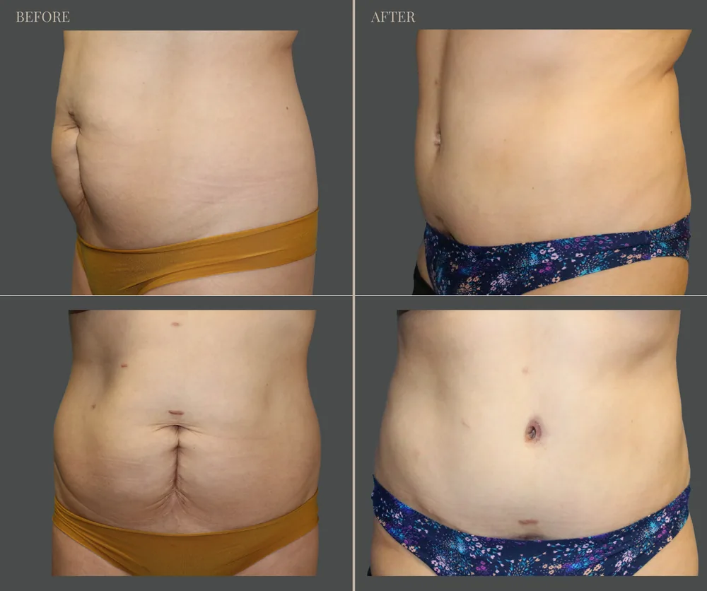 Tummy Tuck Before & After result 6