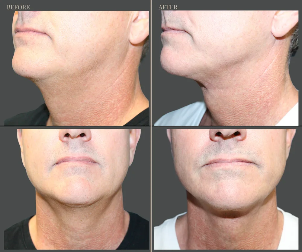 Neck Lift Before & After result 11