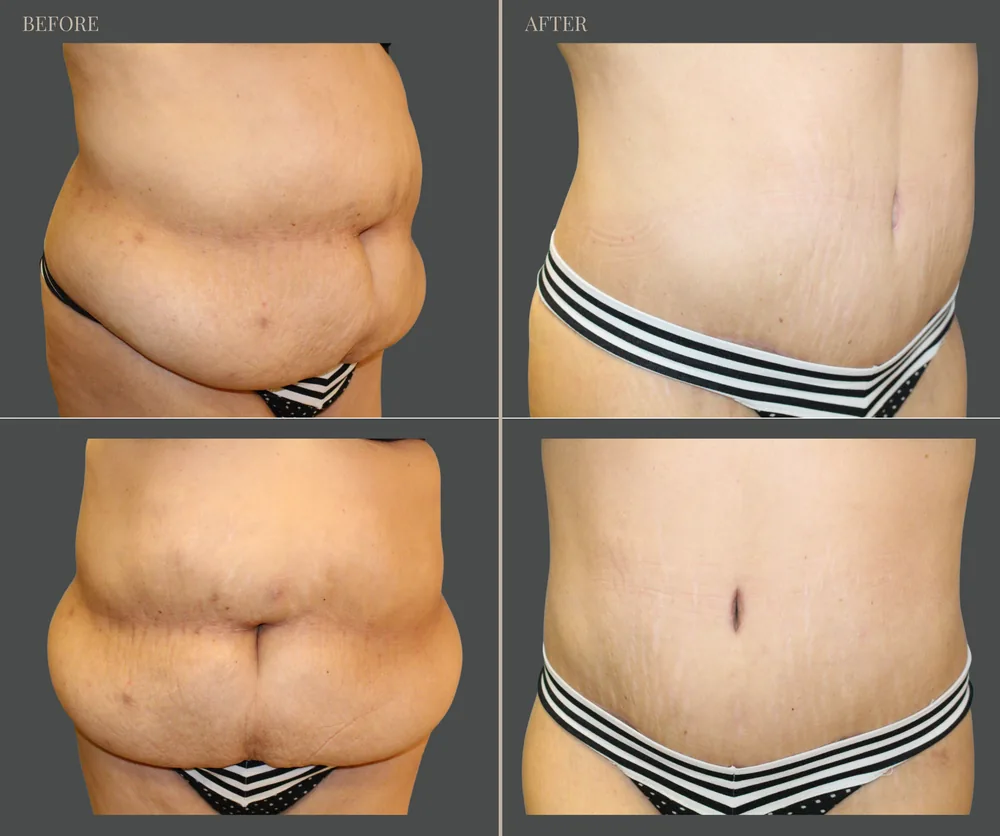 Tummy Tuck Before & After result 15