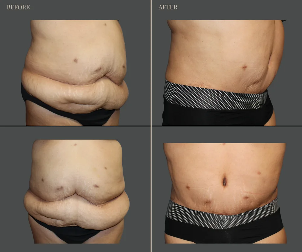 Tummy Tuck Before & After result 27
