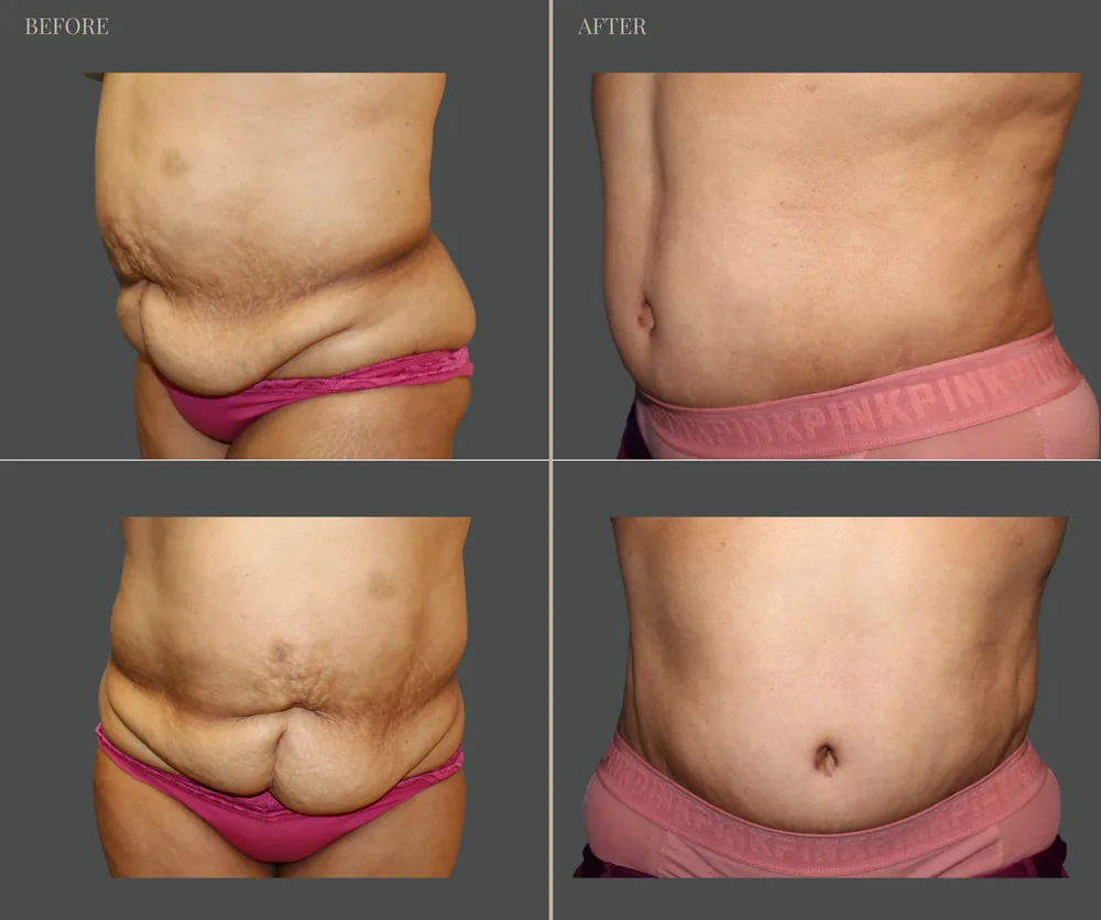 Tummy Tuck Before & After result 32