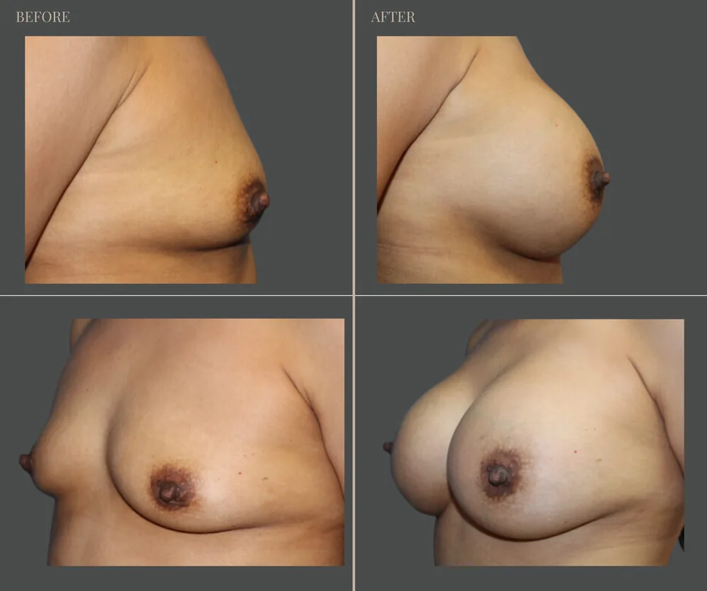 Breast Augmentation Before & After result 27