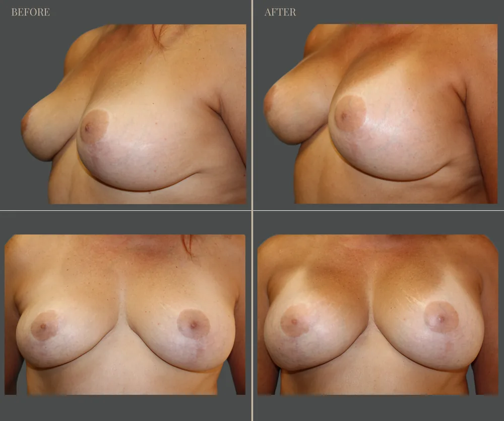 Breast Augmentation Before & After result 22