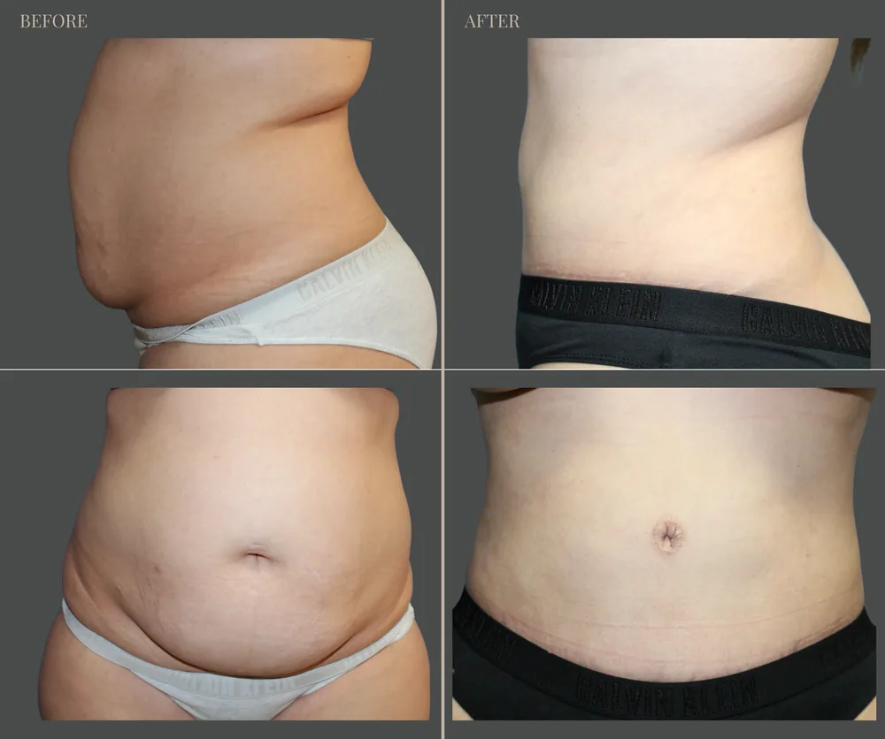 Tummy Tuck Before & After result 7