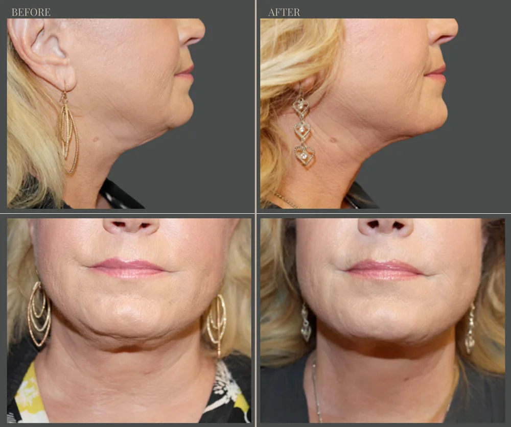 Neck Lift Before & After result 6