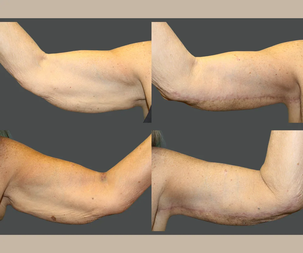 Arm Lift Before & After result 4