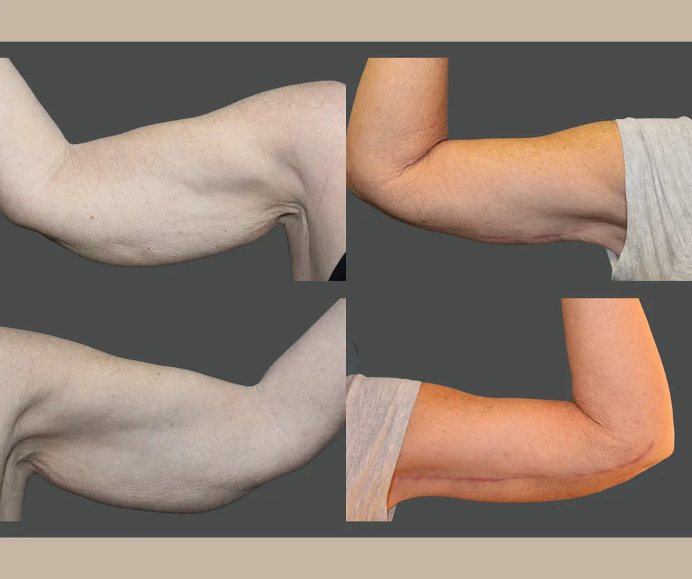 Arm Lift Before & After result 8