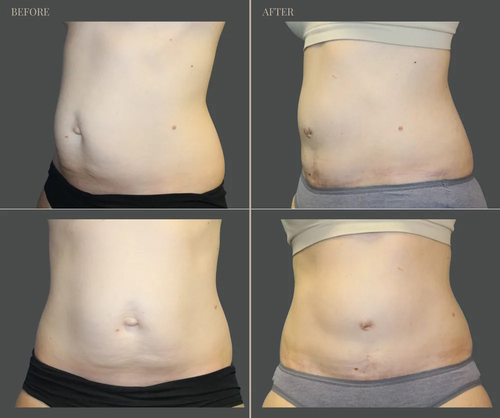 Tummy Tuck Before & After result 12