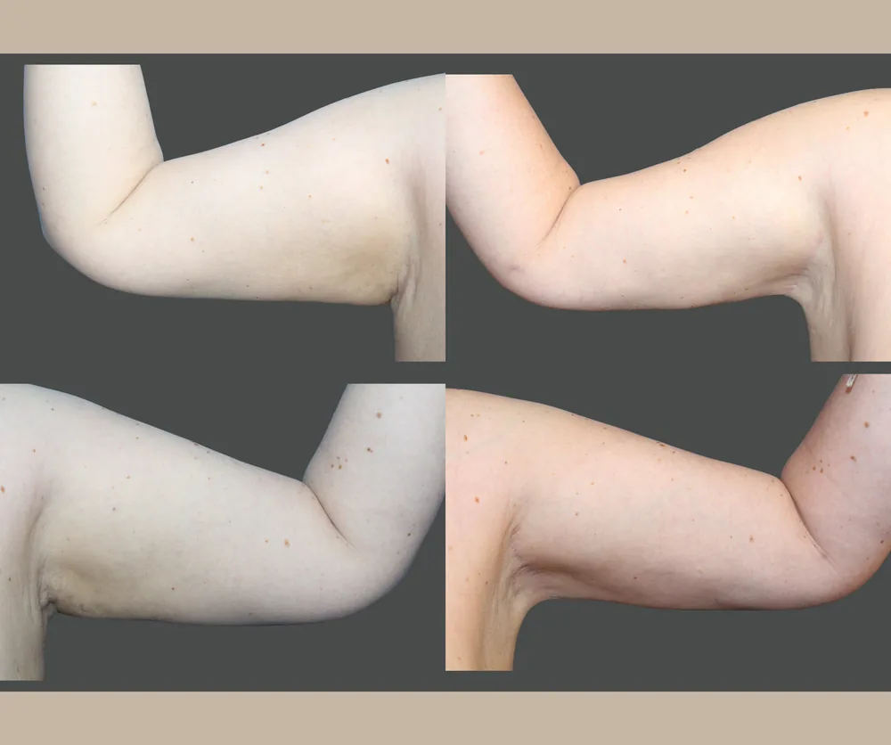 Arm Lift Before & After result 7