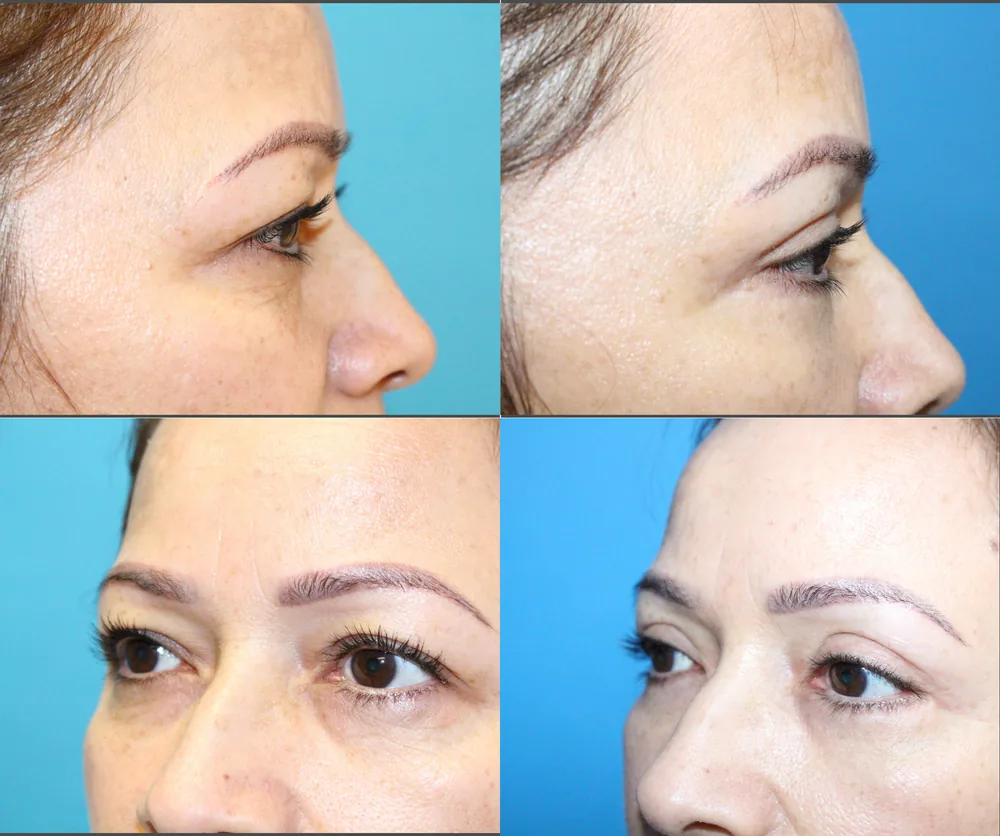 Eyelid Surgery Before & After result 13