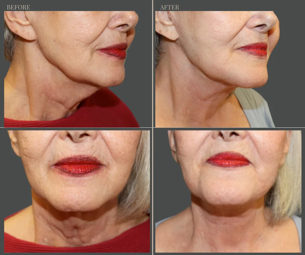 Neck Lift Before & After result 4