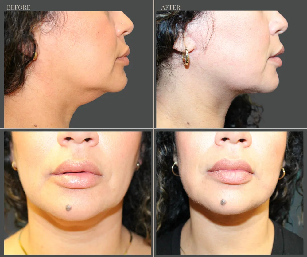 Neck Lift Before & After result 12