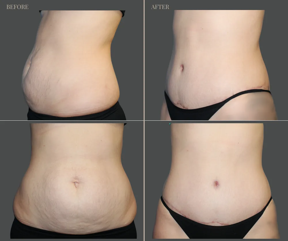 Tummy Tuck before-and-after result 2