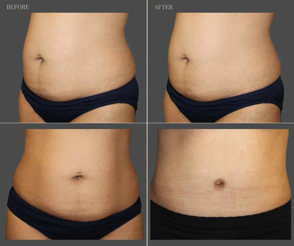 Tummy Tuck Before & After result 9