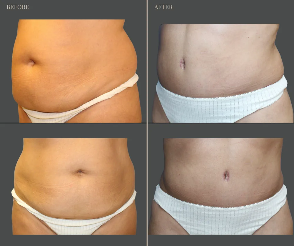 Tummy Tuck Before & After result 29