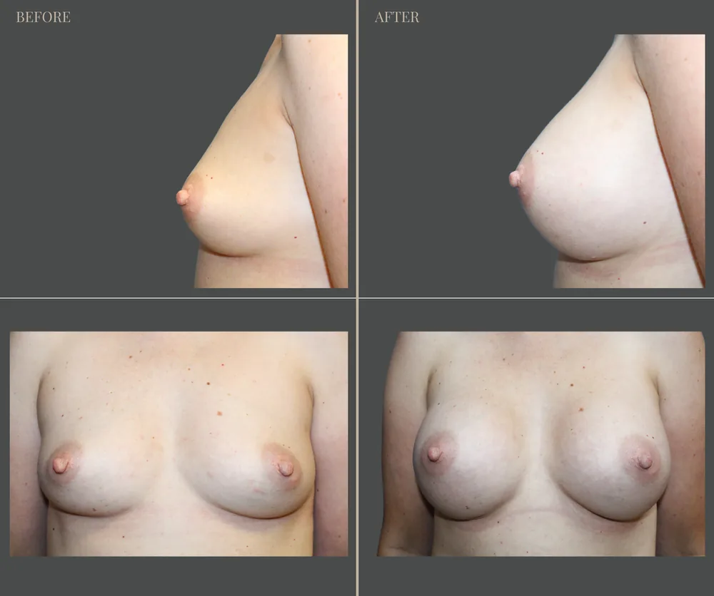 Breast Augmentation Before & After result 5