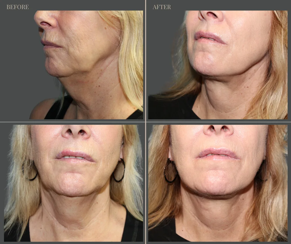 Neck Lift Before & After result 7
