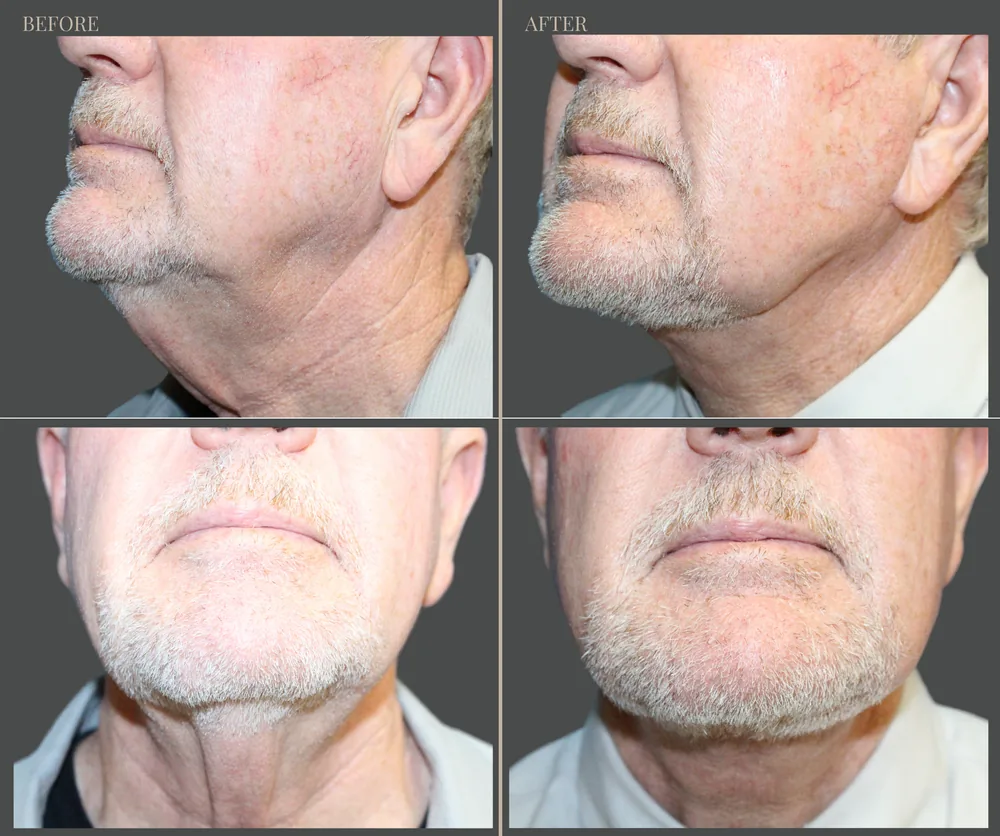 Neck Lift Before & After result 9