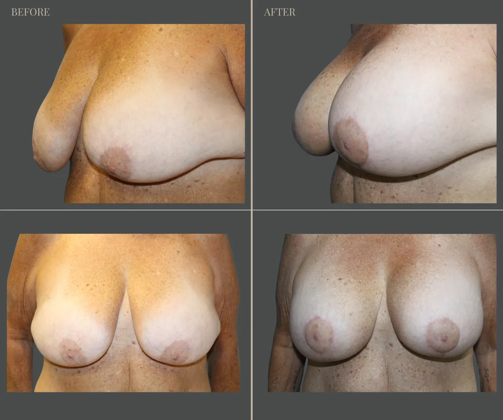 Breast Augmentation Before & After result 20