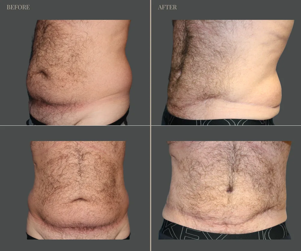 Tummy Tuck Before & After result 35