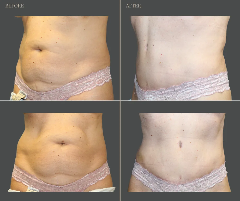 Tummy Tuck Before & After result 34