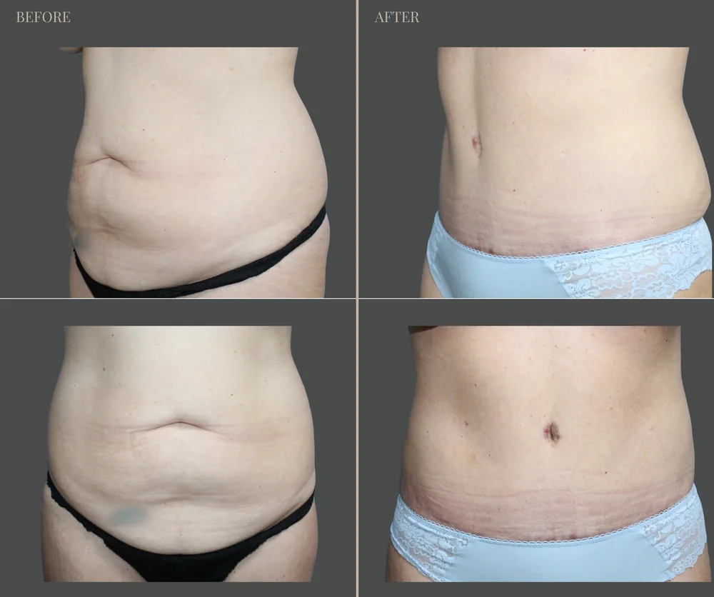 Tummy Tuck Before & After result 20