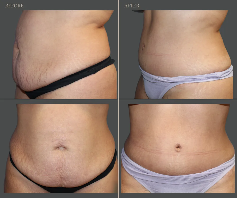 Tummy Tuck Before & After result 11
