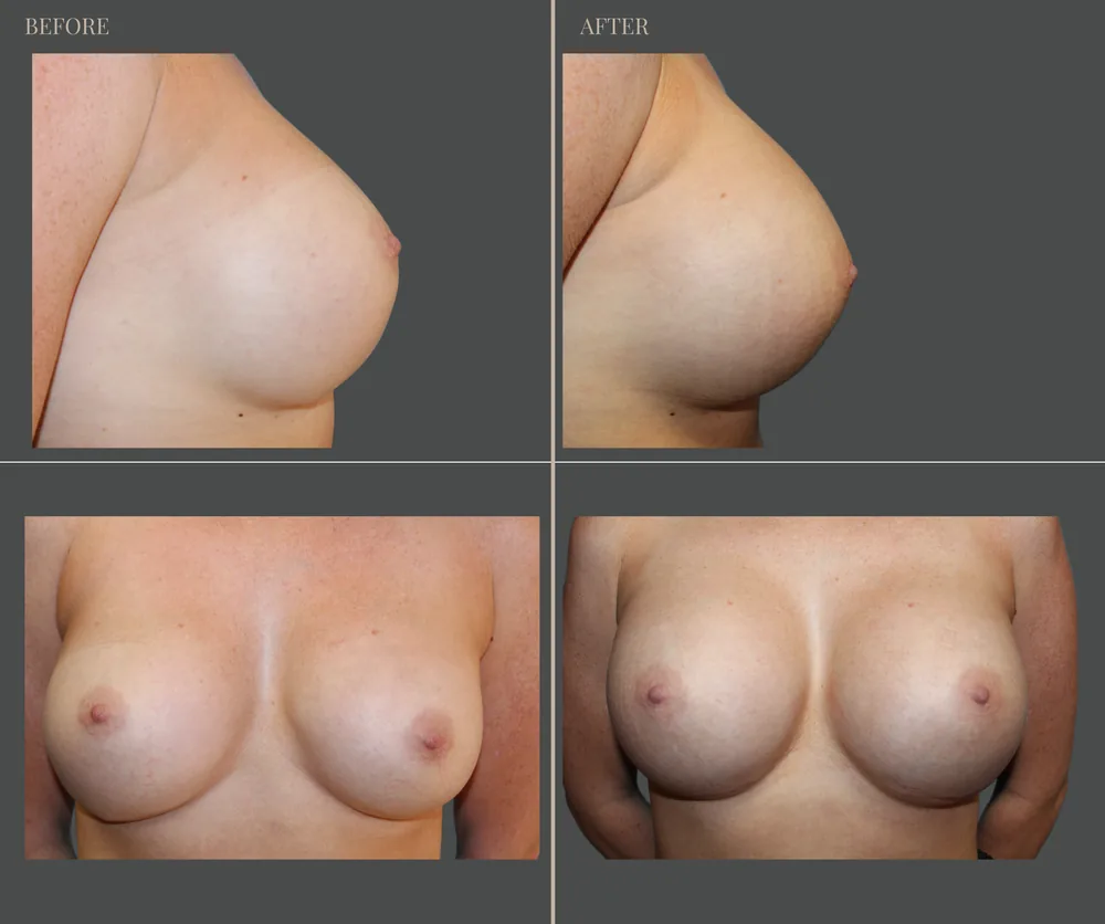 Breast Augmentation Before & After result 33