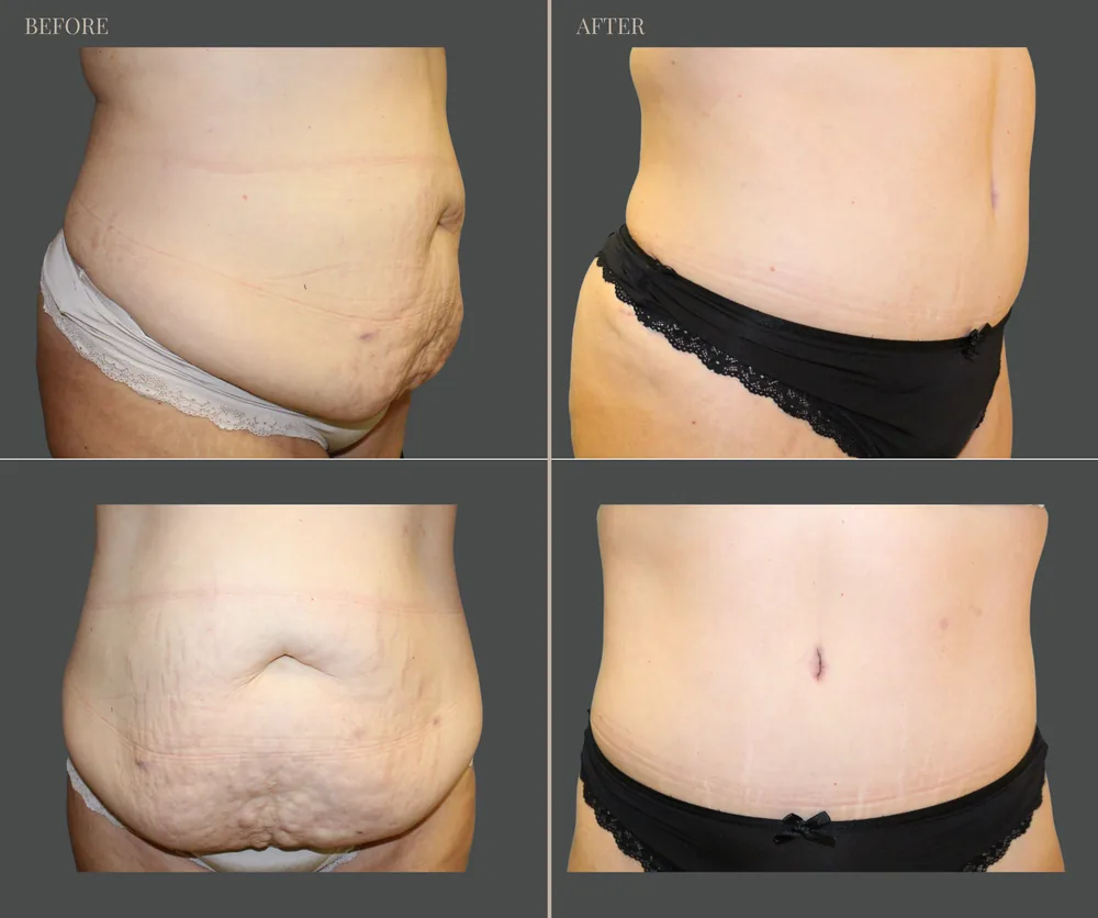 Tummy Tuck Before & After result 13