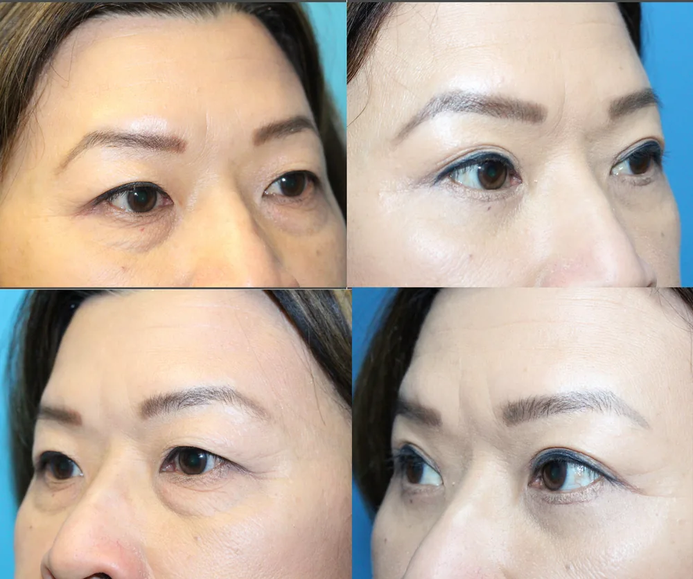 Eyelid Surgery Before & After result 14