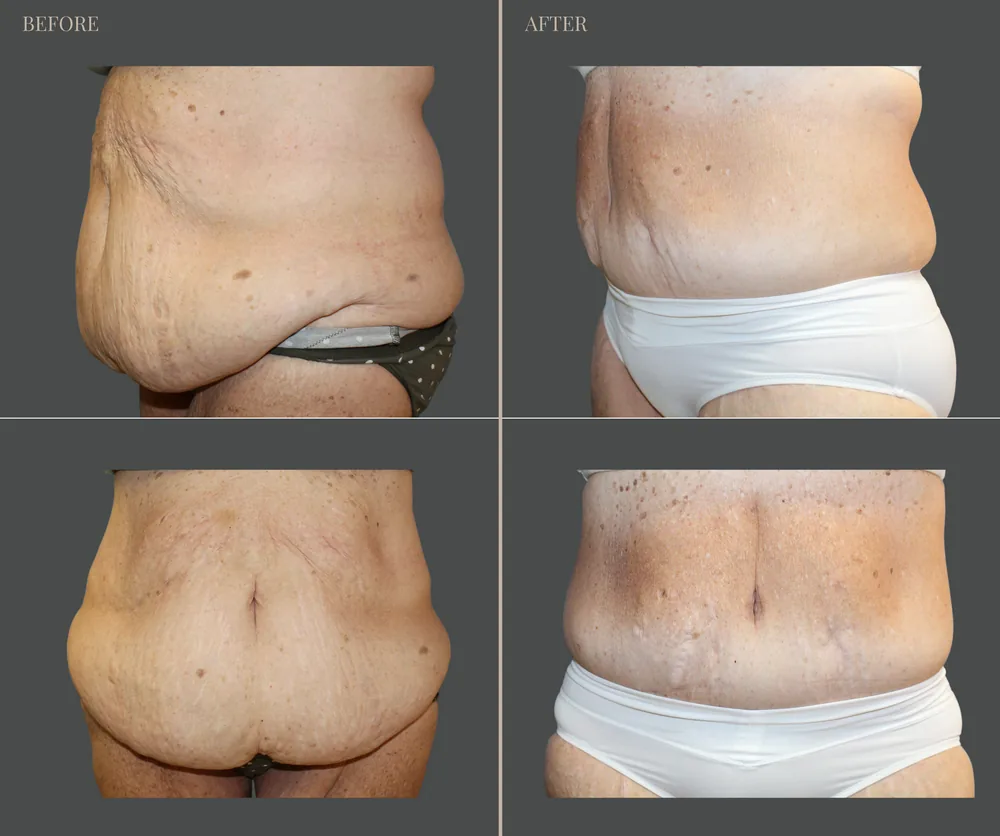 Tummy Tuck Before & After result 38
