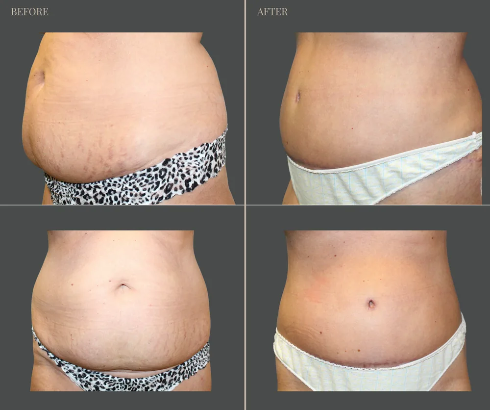 Tummy Tuck Before & After result 36