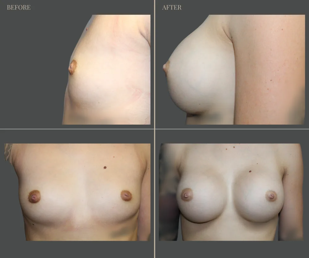 Breast Augmentation Before & After result 19