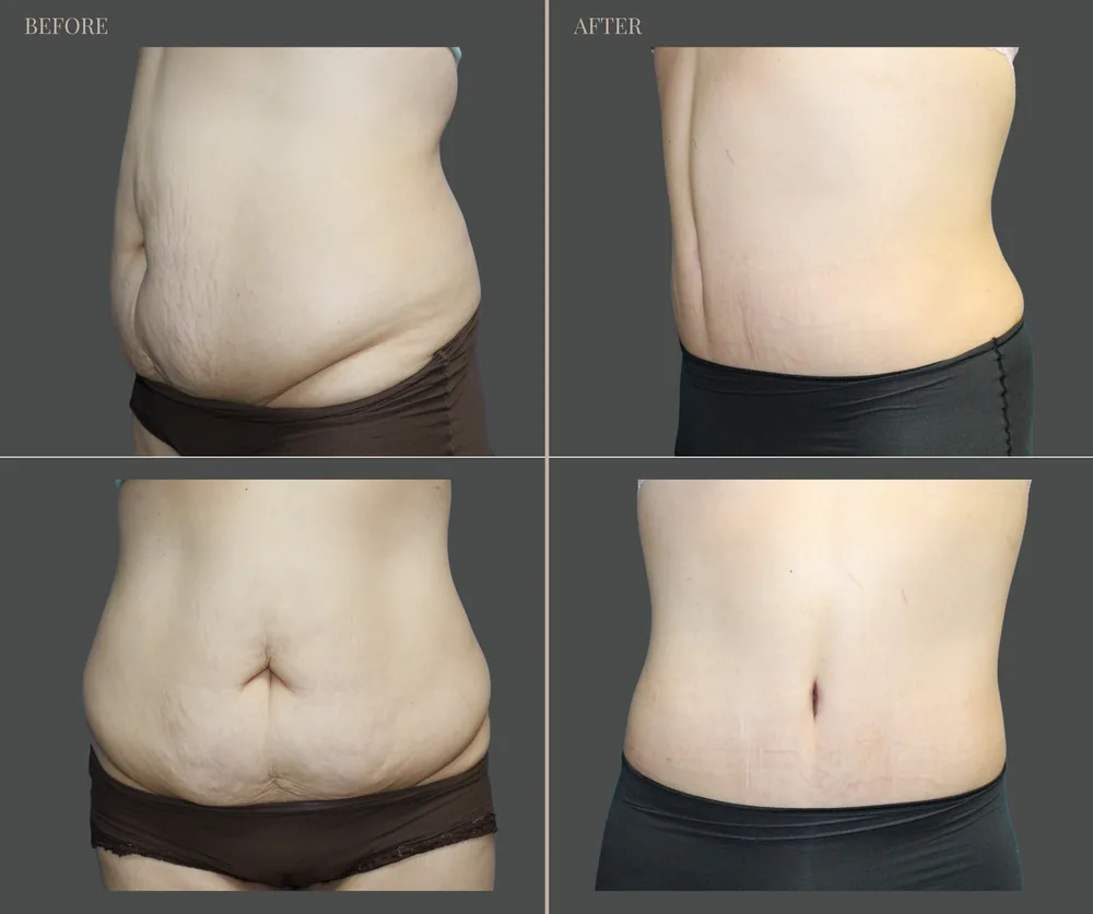 Tummy Tuck Before & After result 8