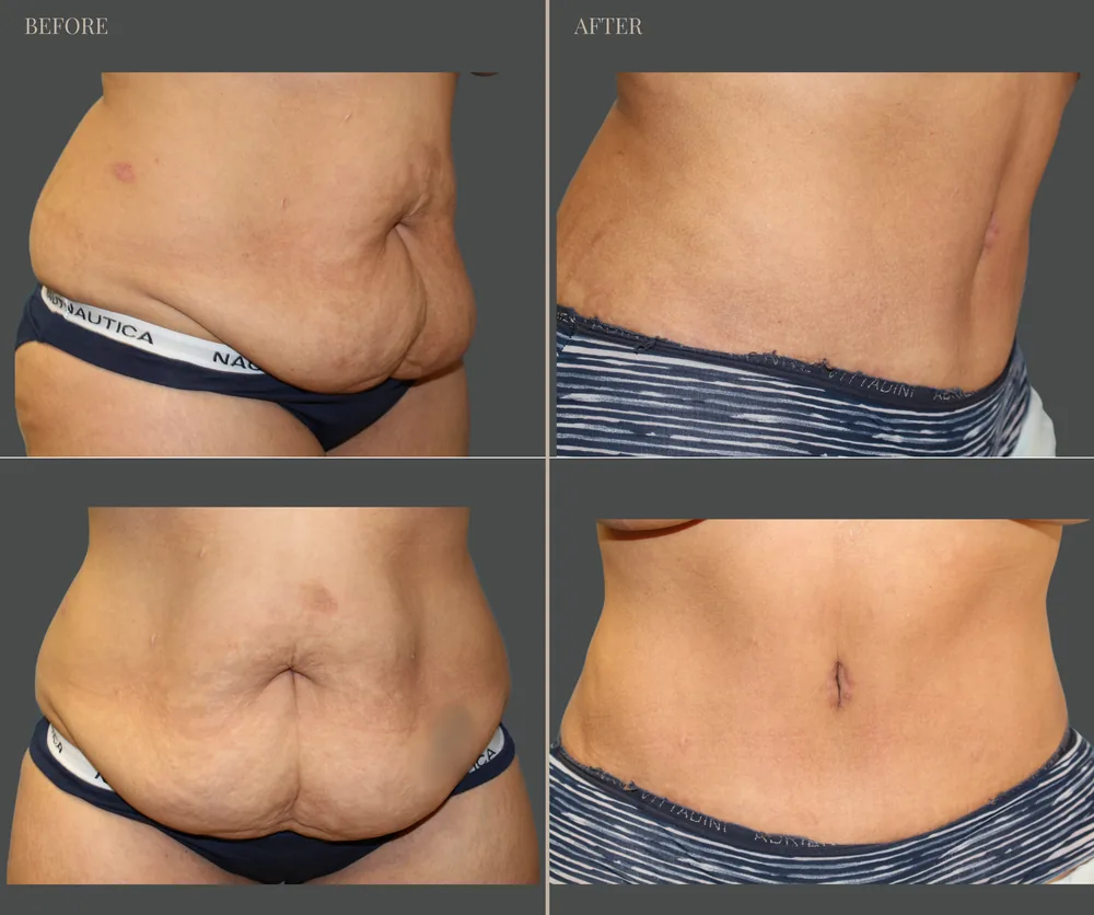 Tummy Tuck Before & After result 24