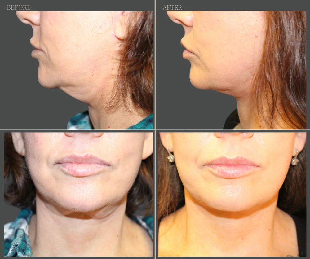 Neck Lift Before & After result 10