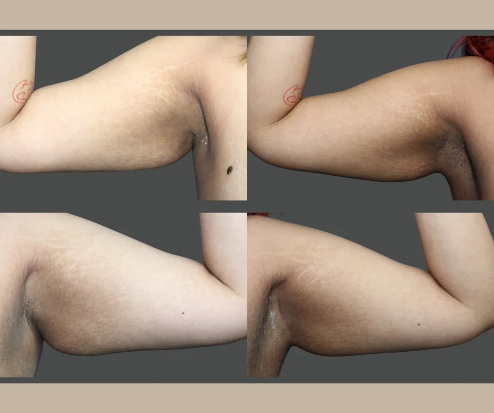 Arm Lift Before & After result 5